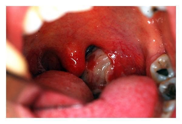 This clinical photograph shows an intraoral view of the oropharynx, demonstrating acute tonsillopharyngitis. There is generalized, intense hyperemia (redness) and congestion of the pharyngeal mucosa and palatine tonsils. Significant edema is visible in the uvula and the anterior tonsillar pillars. The left tonsil is prominently enlarged and almost entirely covered with a thick, diffuse, whitish-yellow purulent exudate. The right tonsil also appears hyperemic and swollen, though the exudate is more localized on the left. The image serves as an educational example of severe pharyngeal infection, illustrating physical findings such as exudative tonsillitis, which can be seen in various bacterial (e.g., Chlamydia trachomatis, Group A Streptococcus) or viral (e.g., Infectious Mononucleosis) etiologies. The educational focus is on the visual identification of tonsillar hypertrophy, purulent coating, and surrounding soft tissue inflammation.