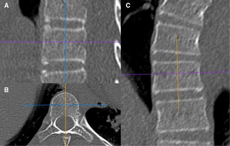 This composite diagnostic image displays three orthogonal CT (Computed Tomography) views of the human spine, demonstrating vertebral anatomy in sagittal, transverse, and coronal planes. Panel A (sagittal) shows a vertical stack of rectangular vertebral bodies with clear superior and inferior endplates and visible internal trabecular patterns. Panel B (transverse/axial) illustrates a single vertebra showing the anterior vertebral body, the posterior vertebral arch (pedicles and laminae), the central vertebral foramen for spinal cord passage, and the spinous and transverse processes. Panel C (coronal) provides a longitudinal view of the vertebral column. Cross-sectional reference lines (blue, purple, and orange) indicate the exact slicing planes and region-of-interest (ROI) orientations used for Hounsfield Unit (HU) bone density measurements. This diagnostic set is used to evaluate vertebral bone quality, cortical thickness, and anatomical orientation, specifically in the context of preoperative planning for spinal procedures such as pedicle screw fixation.