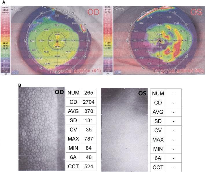 This ophthalmic diagnostic image displays a comparison between the right eye (OD) and left eye (OS) using corneal topography and endothelial cell analysis. Panel A shows Tangential Anterior corneal topography maps. The OD topography demonstrates a relatively regular, prolate corneal surface with central power values between 39.0 and 44.0 Diopters (yellow-green spectrum). In contrast, the OS topography reveals significant irregularity and steepening, characterized by a disorganized color gradient and highly variable dioptric values, indicating severe corneal distortion. Panel B presents specular microscopy for endothelial cell quality detection. The OD image displays a healthy, well-defined hexagonal endothelial mosaic with a cell density (CD) of 2704 cells/mm² and central corneal thickness (CCT) of 524 µm. The OS image shows a complete loss of cellular detail and severe opacity, with no quantitative data (NUM, CD, AVG) obtainable. This visual evidence suggests profound corneal pathology in the left eye, consistent with severe corneal edema or endophthalmitis, while the right eye maintains normal physiological parameters.