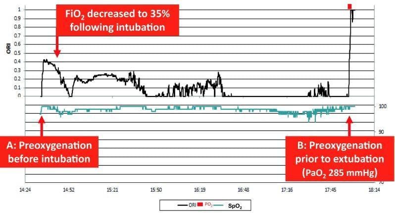 This clinical graphic illustrates the real-time monitoring of Oxygen Reserve Index (ORI) and arterial oxygen saturation (SpO2) in a patient during the perioperative period. The chart displays two primary monitoring windows: (A) pre-oxygenation before tracheal intubation and (B) pre-oxygenation prior to extubation. The ORI (black line), a unit-less index ranging from 0.00 to 1.00, reflects oxygenation status in the moderate hyperoxic range (PaO2 ~100–200 mmHg). During initial pre-oxygenation (A), the ORI sharply rises to approximately 0.4 while SpO2 remains stable near 100%. Following intubation, the FiO2 is reduced to 35%, causing a significant drop in ORI to values fluctuating between 0.0 and 0.2, effectively avoiding hyperoxia. In phase (B), pre-oxygenation before extubation triggers a sharp spike in ORI toward its maximum value, indicating a robust oxygen reserve. This tool provides non-invasive clinical insight into oxygenation levels when SpO2 is already maximized and non-informative, allowing for safer airway management and precise titration of supplemental oxygen.