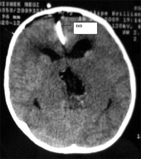 This diagnostic image is an axial noncontrast CT scan of the head, capturing a postoperative view (Day 1) following neurosurgical intervention. The scan highlights an external ventricular drain (EVD) in situ, appearing as a linear, high-density (hyperdense) structure originating from the right frontal scalp, traversing the parenchyma, and terminating in the anterior aspect of the right lateral ventricle. The lateral ventricles show significant ventriculomegaly with distortion of their typical anatomy. Centrally, a large hypodense area is visible, representing the operative site cavity or residual tumor bed within the supratentorial compartment. The image demonstrates common radiological findings associated with the management of hydrocephalus or obstructive intracranial masses, specifically illustrating the hardware placement for cerebrospinal fluid diversion and the structural changes following surgical debulking. Clinical relevance includes assessing EVD positioning, monitoring for postoperative hemorrhage, and evaluating ventricular size changes in response to drainage.