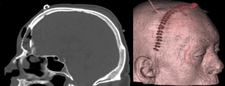 This composite clinical image displays a postoperative evaluation of a patient who underwent surgical management for a frontal sinus mucocele. Left: A sagittal non-contrast CT scan of the head demonstrates the reconstruction of the frontal sinus anterior wall. A high-density, linear, beaded structure representing a titanium mesh is visible, spanning the osseous defect in the frontal bone to restore the cranial contour. The underlying sinus appears obliterated with soft-tissue density material, consistent with the reported fat graft and fascia lata packing. Right: A 3D surface rendering of the patient’s head in profile shows the external cosmetic results and surgical site. A distinct, reddish-brown corrugated line follows a coronal trajectory across the scalp, representing a surgical incision site closed with metallic staples or sutures. The reconstruction provides a smooth forehead contour without significant depression, demonstrating the efficacy of the cranioplasty. This image is an educational resource for neurosurgery and otolaryngology, illustrating surgical reconstruction of the frontal sinus following bony erosion.
