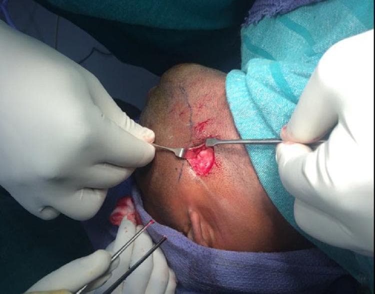 This clinical photograph captures an intraoperative view of a retromandibular transmasseteric surgical approach for the treatment of a mandibular condylar fracture. The image shows a patient in a supine position with the head draped, revealing the surgical site inferior to the earlobe and posterior to the mandibular ramus. Preoperative surgical markings are visible on the skin. The initial incision has been carried through the skin and subcutaneous tissue, with surgeons using hand-held retractors and forceps to expose the underlying platysma muscle. The exposed muscle tissue appears reddish and fibrous, representing the layer immediately deep to the superficial fascia. This visual serves to teach the anatomical layers encountered during maxillofacial surgery and the specific surgical access required for open reduction and internal fixation (ORIF) of condylar fractures, emphasizing the proximity to vital structures like the facial nerve and retromandibular vein.