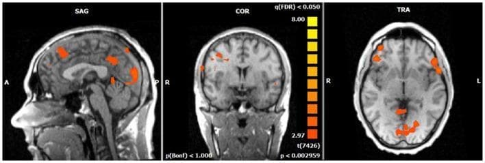 A functional MRI (fMRI) statistical map overlaid on a T1-weighted structural brain template, demonstrating Blood Oxygen Level Dependent (BOLD) activity in healthy subjects during a voluntary selection task. The image displays three standard planes: Sagittal (SAG), Coronal (COR), and Transverse/Axial (TRA). Significant activations are represented by a heat map ranging from orange to yellow, corresponding to t-values from 2.97 to 8.00 at a False Discovery Rate (q(FDR) < 0.05). In the sagittal view, increased BOLD responses are visible in the medial and lateral frontal regions, as well as the posterior cortex. The coronal and transverse views confirm bilateral but asymmetrical activation clusters, primarily located in the superior and middle frontal gyri (BA 6/8/9/46) and the dorsolateral prefrontal cortex. Distinct posterior activity is localized to the cuneus (BA 7/18/19) and the medial posterior regions. This clinical imaging set illustrates the functional neuroanatomy associated with the N2 event-related potential component, highlighting the cognitive control network involved in response selection.