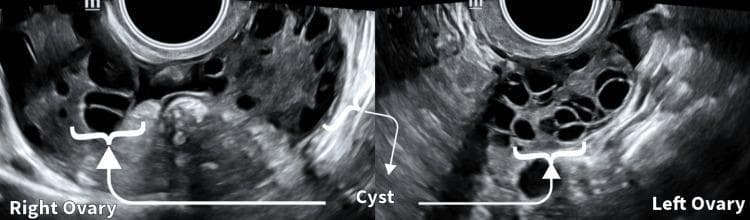 This diagnostic image is a side-by-side transvaginal ultrasound (sonography) displaying the right and left ovaries in a 31-year-old female patient on day 2 of her menstrual cycle. The modality is gray-scale ultrasound, showing transverse or longitudinal views of the pelvic adnexa. Both ovaries demonstrate significant polycystic morphology, characterized by an increased number of small, peripherally arranged follicles and a dense stroma. The right ovary shows multiple scattered anechoic (dark) cysts, while the left ovary displays a more crowded, classic 'string of pearls' or honeycomb appearance with densely packed fluid-filled follicles. These findings are consistent with the clinical diagnosis of Polycystic Ovary Syndrome (PCOS). The image labels highlight specific cystic structures within the enlarged ovarian volume. The educational focus is on identifying diagnostic sonographic criteria for PCOS, including follicular count, size, and distribution within the ovarian stroma during a clinical evaluation for symptoms like irregular cycles and hirsutism.