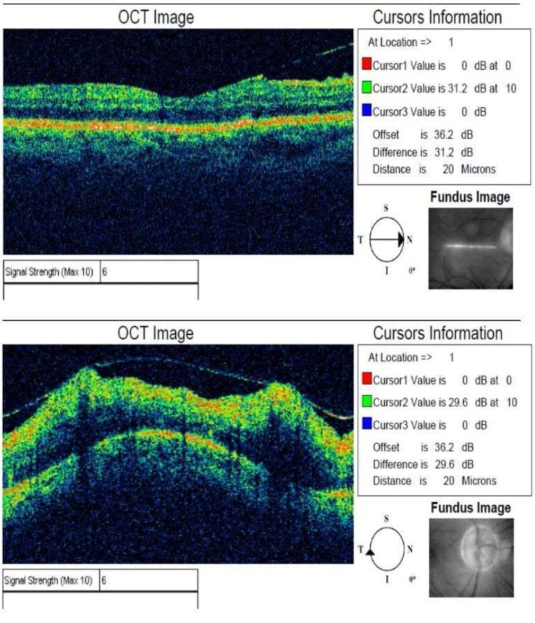 Two high-resolution Optical Coherence Tomography (OCT) cross-sectional images of the retina from a right eye (OD). The top panel displays a relatively normal macular profile with distinct hyperreflective bands representing the Retinal Pigment Epithelium (RPE) and Bruch's membrane, and lower reflectivity in the inner retinal layers. The bottom panel demonstrates significant pathological alterations, including a highly irregular and elevated retinal surface consistent with macular edema or tractional changes. Each OCT scan is accompanied by 'Cursors Information' quantifying signal intensity (dB) and distances (20 microns), and a small 'Fundus Image' showing the scan orientation—a horizontal line through the macula in the first and a circular scan around the optic disc in the second. Both scans report a Signal Strength of 6/10. These images illustrate diagnostic imaging used in ophthalmology for monitoring retinal diseases, comparing baseline structural integrity against active pathology such as macular distortion or thickening.
