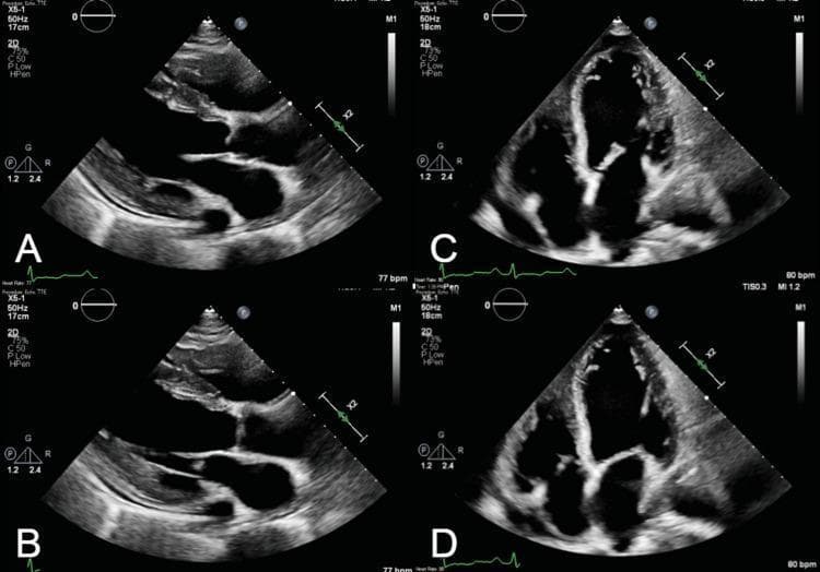 Transthoracic echocardiography (TTE) images presenting four grayscale views of a heart with severe dilated cardiomyopathy. Panels A and B display the parasternal long-axis view (PLAX) in diastole and systole, respectively. These views reveal massive dilatation of the left ventricle (LV) and left atrium (LA), with the LA significantly larger than the adjacent aortic root. The mitral valve leaflets appear prominent, and the systolic frame (B) shows restricted leaflet coaptation. Panels C and D show the apical four-chamber view (A4C) in diastole and systole. There is striking biatrial and biventricular dilatation, giving the heart a globular appearance. A comparison between the diastolic (C) and systolic (D) phases demonstrates minimal change in ventricular cavity size, indicating a severely reduced ejection fraction (EF approximately 20%) and global hypokinesis. The right ventricle (RV) is also markedly dilated, nearly reaching the size of the enlarged left ventricle. These findings are characteristic of advanced heart failure with multi-chamber enlargement.
