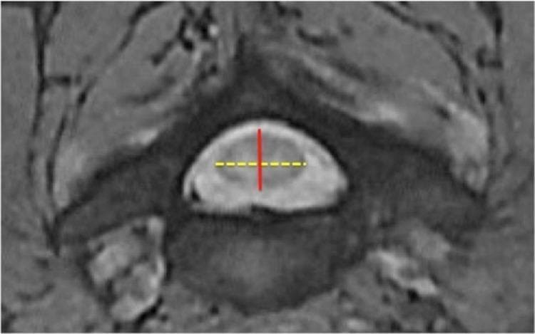 This diagnostic axial cross-section, likely from an MRI or CT myelogram, shows the cervical spinal cord within the spinal canal at the disc level. The central spinal cord is depicted as a homogenous, elliptical structure with well-defined boundaries. Superimposed on the cord are two measurement indicators: a vertical solid red line representing the Anteroposterior Cord Diameter (APCD) and a horizontal dotted yellow line representing the Transverse Cord Diameter (TCD). The surrounding anatomy includes the ventral vertebral body and posterior elements such as the lamina and pedicles, which define the limits of the spinal canal. This imaging is clinically used to assess for cervical spondylotic myelopathy (CSM) by calculating compression ratios (APCD/TCD) and monitoring for cord stenosis. The educational focus is on the radiological quantification of spinal cord dimensions for identifying pathological narrowing or compression in patients presenting with myelopathic symptoms.