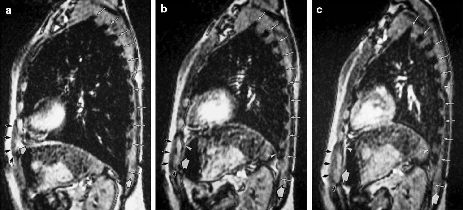 This diagnostic image set consists of three sagittal magnetic resonance (MRI) scans of the human thorax, illustrating the relationship between the diaphragm, rib cage, and lung volumes at different respiratory stages: (a) Total Lung Capacity (TLC), (b) Functional Residual Capacity (FRC), and (c) Residual Volume (RV). The images demonstrate the mechanics of the 'zone of apposition' (ZOA)—the area where the diaphragm muscle is directly opposed to the inner rib cage. At TLC (a), the diaphragm is flattened, and the ZOA is nearly zero, with the anterior insertion (white arrowhead) close to the lower ribs (black arrows). At FRC (b) and RV (c), the diaphragm domes cranially, significantly increasing the ZOA as shown by the rising upper limits (thin white arrowheads). The scans also highlight changes in thoracic geometry; as volume decreases from TLC to RV, the rib cage descends and intercostal spaces visibly narrow. This series is an educational tool for pulmonary physiology, demonstrating diaphragmatic excursion and its contribution to inspiratory capacity.