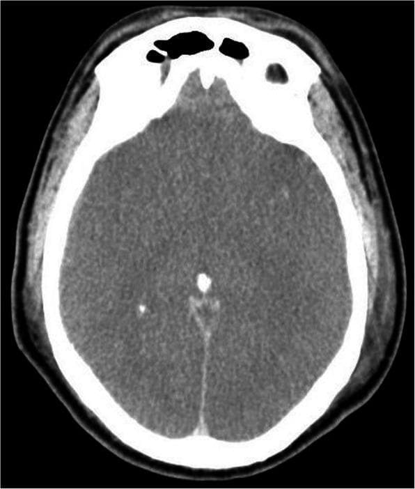 This diagnostic image is an axial non-contrast computed tomography (CT) scan of the brain demonstrating features of diffuse cerebral edema. The scan shows a global loss of the normal grey-white matter differentiation, which is a classic sign of severe brain swelling or global hypoxic-ischemic injury. The cerebral sulci and cisterns are effaced, indicating significant mass effect and increased intracranial pressure as the brain parenchyma expands against the rigid skull. A hyperdense midline structure corresponding to the interhemispheric fissure is visible, along with small hyperdense foci likely representing calcified pineal or choroid plexus structures. The surrounding skull appears intact with normal density. Extracranial soft tissue swelling is also noted. Clinically, these findings are highly significant in the context of severe sepsis or meningitis, where progressive swelling can lead to brain herniation or brain death if not managed aggressively. This image serves as a critical educational example of generalized intracranial hypertension and its radiographic manifestations in emergency medicine and neurology.