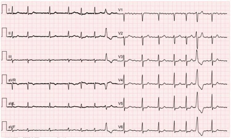 A standard 12-lead diagnostic electrocardiogram (ECG) printed on red grid paper demonstrating atrial fibrillation with a single premature ventricular complex (PVC). The rhythm is characterized by an 'irregularly irregular' pattern of R-R intervals and the absence of organized P waves, which are replaced by low-amplitude fibrillatory waves most visible in the inferior leads (II, III, aVF) and lead V1. The majority of the QRS complexes are narrow (<120 ms), indicating normal intraventricular conduction. A single wide, bizarrely shaped QRS complex is observed towards the end of the tracing, representing a premature ventricular complex (PVC). The T waves are generally concordant with the QRS complexes except for the compensatory pause following the PVC. This diagnostic image is a classic educational example of an atrial arrhythmia with associated ectopic ventricular activity, relevant for medical education in cardiology and emergency medicine to teach rhythm identification and ECG interpretation.