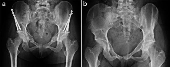 This diagnostic image displays a side-by-side comparison of two anteroposterior (AP) view radiographs of the pelvis, illustrating the progression and healing following a periacetabular osteotomy (PAO) for hip dysplasia. Radiograph (a) shows the immediate post-operative state with surgical hardware in situ. Multiple metallic cortical screws are visible, oriented from the superior ilium into the acetabular fragments to provide internal fixation across the osteotomy sites. The surgical cuts (osteotomies) around the acetabulum are visible as faint radiolucent lines. Radiograph (b) demonstrates the same pelvis at a later stage after hardware removal. The acetabular fragments have successfully united, evidenced by the absence of osteotomy lines and the presence of smooth cortical remodeling. The pelvic ring is intact, and the hip joints show improved femoral head coverage. This comparison illustrates the typical healing sequence from internal stabilization to complete bony consolidation after surgical correction of acetabular morphology.