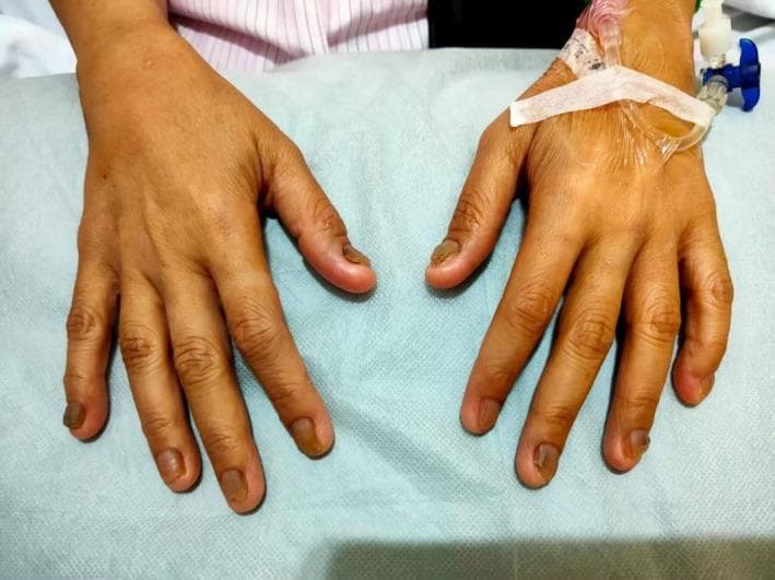 This clinical photograph displays the dorsal surface of both hands of a patient against a medical drape. The primary focus is the prominent nail pathology consistent with koilonychia (spoon nails). The fingernails exhibit a characteristic concave, upward-curving shape, appearing flattened or scooped out. Additionally, there is significant chromonychia characterized by brownish discoloration, with some nails showing hyperpigmented, dark areas near the distal and lateral margins. The nails appear thin and brittle in texture. An intravenous (IV) catheter is secured with white adhesive tape on the dorsum of the right hand, indicating an acute clinical setting. These physical findings are classic cutaneous markers of chronic iron deficiency anemia and are relevant to systemic conditions such as Plummer-Vinson syndrome. The image serves as a diagnostic educational resource for identifying dermatological manifestations of systemic hematologic disorders.
