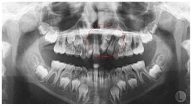 This panoramic radiograph (orthopantomogram) displays a pediatric patient in the mixed dentition stage, featuring a well-defined odontogenic tumor in the anterior maxilla. Circled in red, the lesion is characterized as a compound or complex odontoma located in the region of the maxillary left central and lateral incisors. The mass presents as a cluster of heterogeneous radiopaque structures with varying densities, some resembling rudimentary tooth elements (denticles) with enamel-like and dentin-like radiopacity. Clinically, the odontoma is causing significant local dental interference, specifically the impaction and displacement of the adjacent permanent maxillary incisors. The surrounding dentition shows normal developmental progress for the age group, with visible permanent tooth buds in the mandible and maxilla. The alveolar bone height and quality appear within normal limits outside the pathological site. This diagnostic image serves as a classic educational example of how odontomas act as local etiological factors for tooth impaction and ectopic eruption during dental development.