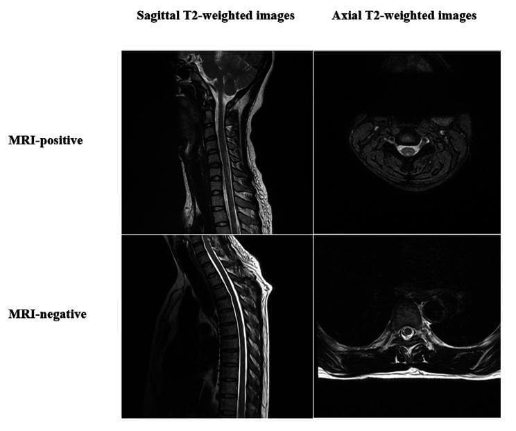 This diagnostic comparison chart displays four T2-weighted magnetic resonance imaging (MRI) scans of the spinal cord, illustrating Idiopathic Acute Transverse Myelitis (IATM). The image is organized into a 2x2 grid comparing MRI-positive and MRI-negative patients across sagittal and axial planes.
In the MRI-positive sagittal view of the cervical spine, a distinct longitudinal area of hyperintense (bright) signal is visible within the spinal cord, indicating inflammation or edema characteristic of active transverse myelitis. The corresponding axial image confirms centrally located high signal intensity within the cord.
In contrast, the MRI-negative sagittal and axial views show a spinal cord with normal morphology and uniform, low-to-intermediate signal intensity, demonstrating a clinical scenario where diagnostic criteria for IATM are met (e.g., via CSF analysis or clinical symptoms) despite unremarkable imaging. These images serve as educational examples for neuroradiology and neurology to differentiate between visible inflammatory lesions and MRI-negative clinical presentations of spinal cord disorders.