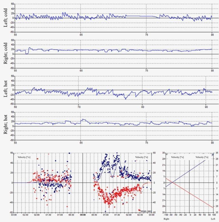 Diagnostic diagnostic traces and charts showing results of a caloric vestibular test, used to assess peripheral vestibular function. The top four panels display Electronystagmography (ENG) or Videonystagmography (VNG) recordings of slow phase velocity (SPV) in degrees per second (°/s) during bithermal caloric irrigation (30°C cold and 44°C hot) for both the left and right ears. The left ear panels demonstrate characteristic nystagmus responses with fluctuating SPV values. In contrast, the right ear panels ('Right; cold' and 'Right; hot') show flat traces with SPV peak values ≤ 5°/s, indicating a diagnosis of right vestibular areflexia. The bottom left quadrant contains a composite scatter plot of nystagmus velocity over time, with red and blue data points representing the fast and slow phases of nystagmus. The bottom right graph provides a summary caloric chart plotting peak velocities to quantify vestibular paresis or directional preponderance. This material is essential for neurology and otolaryngology students studying the diagnostic workup of vertigo, balance disorders, and unilateral vestibular loss.