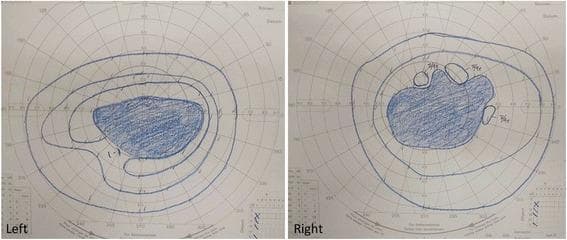 This diagnostic image consists of two Goldmann kinetic perimetry plots representing the left and right eyes of a patient. The plots map the functional integrity of the visual fields. Both eyes demonstrate a large, dense central scotoma, represented by prominent blue-shaded regions occupying the central fixation area. The left eye shows a relatively uniform, horizontally oval central defect. The right eye displays a more irregular central scotoma with adjacent satellite defects and notched borders. Concentric lines, or isopters, indicate the boundaries of peripheral vision for different stimulus intensities; both plots show marked concentric constriction, where the outermost isopters are significantly retracted toward the center compared to a normal physiological range. These findings are clinically significant for severe bilateral loss of central vision and peripheral field narrowing, characteristic of advanced Cancer-Associated Retinopathy (CAR). This visual material is used in ophthalmology and oncology to illustrate paraneoplastic syndromes affecting the retina and the resulting profound visual field deficits.