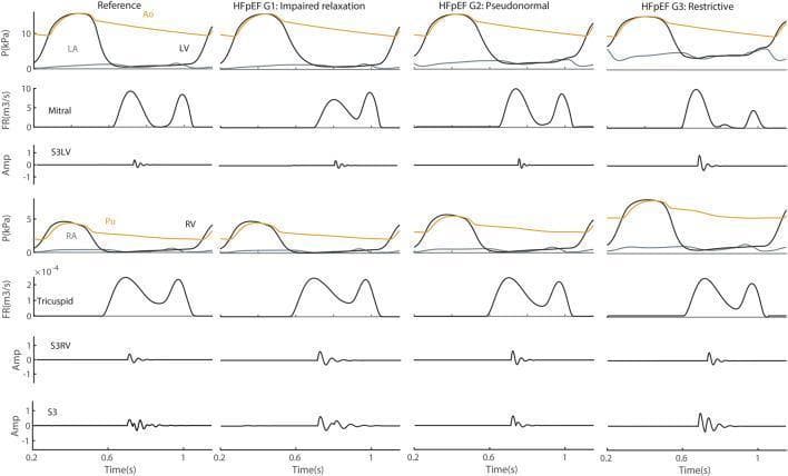 This physiological diagram displays simulated hemodynamic and acoustic waveforms across four stages of cardiac function: Reference, and Heart Failure with Preserved Ejection Fraction (HFpEF) Grade 1 (Impaired Relaxation), Grade 2 (Pseudonormal), and Grade 3 (Restrictive). The panels are organized into columns by disease severity and rows by measurement type, including pressure (P) in the left heart (Ao, LV, LA) and right heart (Pu, RV, RA), flow rate (FR) across mitral and tricuspid valves, and vibration amplitude (Amp) for the left ventricular third heart sound (S3LV), right ventricular S3 (S3RV), and the combined S3 signal. Key educational features include the progressive changes in mitral inflow patterns (transitioning from a normal E/A ratio in Reference to a dominant E-wave and diminished A-wave in Grade 3) and the corresponding increase in S3LV amplitude as diastolic dysfunction worsens. The diagram illustrates the pathophysiology of HFpEF, highlighting how impaired relaxation and increasing ventricular stiffness correlate with the appearance and intensity of the pathological third heart sound (S3 gallop).