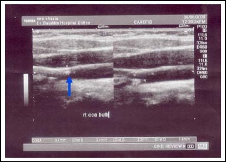 This diagnostic image is a B-mode ultrasound of the right carotid artery bifurcation and bulb in a longitudinal view. The image illustrates a clinical assessment of carotid intima-media thickness (CIMT) and the presence of atherosclerotic disease. The arterial walls show irregular echogenicity with visible hyperechoic foci indicative of calcified plaque formation along the vessel wall. Several calipers (labeled A, B, C, and D) demonstrate the measurement of the intima-media complex, with recorded values ranging from 1.4 mm to 2.4 mm, signifying pathological thickening. A blue arrow highlights a specific area of interest at the carotid bulb where the CIMT is increased. This visual serves as a primary diagnostic indicator for cardiovascular risk assessment in patients with hypercholesterolemia, demonstrating how ultrasound is used to identify early-stage atherosclerosis and structural vascular changes.