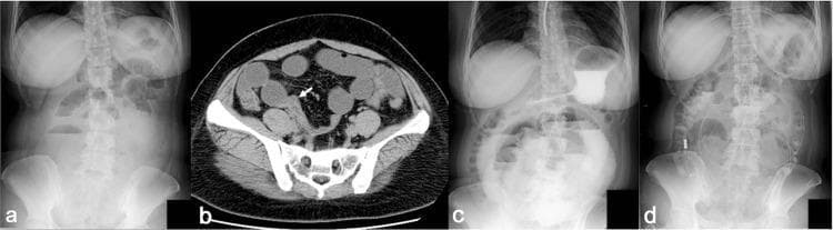 A multi-panel figure illustrating the diagnostic imaging and clinical progression of small bowel obstruction (SBO). Panel A: An upright abdominal X-ray at admission showing multiple dilated small bowel loops with prominent air-fluid levels throughout the central abdomen. Panel B: An axial plain CT scan of the pelvis demonstrating a focal caliber change (arrow) in the right lower quadrant, with proximal fluid-filled and gas-distended small intestinal loops. Panel C: An upright abdominal X-ray following water-soluble contrast (WSC) administration via nasogastric tube, showing recurrent or persistent small bowel distension and multiple air-fluid levels. Panel D: A follow-up upright abdominal X-ray after the placement of a long intestinal decompression tube, showing significant resolution of air-fluid levels and reduced bowel distension. The series demonstrates the transition from mechanical obstruction to successful decompression via an intestinal tube.