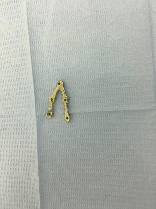 A clinical photograph displaying a customized, milled V-pattern osteosynthesis plate for maxillofacial surgery, specifically designed for mandibular angle fracture fixation. The plate is made of medical-grade titanium with a gold-colored surface finish. It features a characteristic 'V' shape with two divergent arms of unequal length: the longer arm contains three circular screw holes, while the shorter arm contains two screw holes, totaling five apertures for 2 mm bone screws. The plate surface exhibits a slightly irregular, hammered texture resulting from the computer-aided manufacturing (CAM) milling process. This patient-specific implant is designed to align fractured segments while avoiding vital anatomical structures such as the inferior alveolar nerve and tooth apices. The plate is shown resting on a blue sterile surgical drape, highlighting its use in a clinical or laboratory setting.
