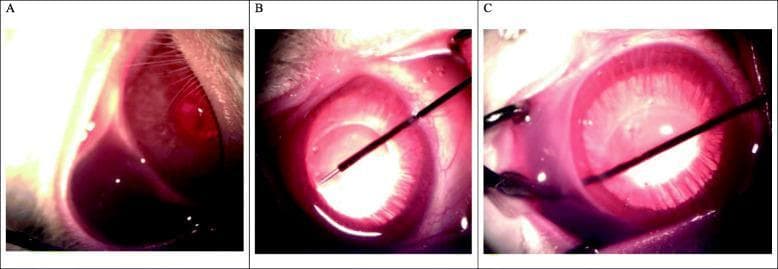 This sequence of three clinical intraoperative photographs (labeled A, B, and C) demonstrates the stages of an ab-interno laser glaucoma procedure in a lab setting. Panel A shows the initial subconjunctival injection of mitomycin C (MMC), resulting in a localized, dark, fluid-filled bleb intended to inhibit postoperative fibrosis. Panels B and C illustrate the surgical approach using a 2940nm Er:YAG thermal-ablating laser system. In Panel B, a thin laser probe is inserted into the anterior chamber through a 1mm clear corneal incision, positioned across the iris plane. Panel C depicts the advancement of the laser probe to perform tissue ablation at the trabecular meshwork, creating a permanent drainage channel (scleral tunnel) from the anterior chamber to the subconjunctival space. The images highlight key landmarks including the cornea, iris, and the surgical instrumentation. This material is designed for advanced ophthalmic surgical training, focusing on minimally invasive glaucoma surgery (MIGS) techniques and the use of adjunct antimetabolites in filtration procedures.