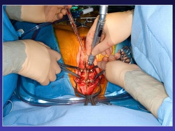 This clinical photograph captures an intraoperative view of a redo median sternotomy in a patient with previous sternal reconstruction. The surgical field demonstrates the use of an oscillating saw to perform a midline osteotomy through the sternal bone. A key feature of this procedure is the management of pre-existing horizontal titanium fixation plates. These plates, which were used for prior sternal wound reconstruction, have been cut at the midline; surgical forceps are being used to pull the plate edges upward and outward. This maneuver facilitates safer re-entry by increasing visualization and space between the oscillating saw and the underlying mediastinal structures. The surrounding surgical site is prepped with iodine-based solution and framed by sterile blue drapes. Visible instrumentation includes the oscillating saw, multiple surgical clamps/forceps for retraction, and suction tubing for fluid management. This image illustrates advanced cardiothoracic surgical techniques for managing complex sternal re-operations in the context of prior deep sternal wound infection (DSWI) and hardware fixation.