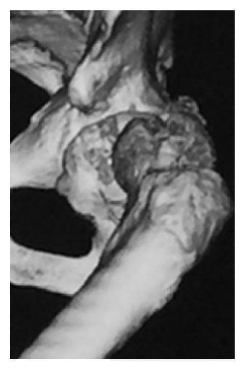 This diagnostic image is a 3D reconstruction from a Computed Tomography (CT) scan focusing on the left hip joint. It demonstrates a posterior redislocation of the hip, characterized by the femoral head being completely displaced outside of its anatomical position within the acetabulum. Significant pathology is visible at the articulation site, specifically an impaction injury where the posterior margin of the acetabulum has created a distinct depression or 'indentation' in the posterior aspect of the femoral head. There is also evidence of cortical irregularity and fragmentation at the posterior acetabular wall, consistent with a posterior wall fracture. The proximal femur and pelvic structures (ilium and ischium) are clearly visualized, illustrating the severe loss of joint congruity. This image serves as a clinical example of traumatic hip instability and the associated bony complications, such as impaction fractures, that can occur during recurrent dislocation events in orthopedic surgery and trauma medicine.