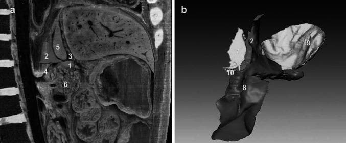 This educational image displays the complex anatomical relationships of the omental bursa (lesser sac) using a combination of a sagittal computerized tomography (CT) scan (Figure a) and a 3D anatomical reconstruction (Figure b). Figure a shows a sagittal plane identifying the foramen bursae omenti majoris (1), gastric bare area (2), hepatogastric ligament (3), left gastric artery (4), caudate lobe of the liver (5), and pancreas (6). The superior recess (7) is demonstrated with the caudate lobe serving as its right border and the hepatogastric ligament positioned anteriorly. Figure b provides an anterior 3D visualization of the communicative pathways between the superior and inferior recesses. It highlights the spatial configuration of the superior recess (7), inferior recess (8), splenic recess (9), and the vestibulum bursae omentalis (10). This visual resource is designed for advanced medical education to assist in understanding potential pathways for pancreatic fluid collections and surgical approaches to the lesser sac.