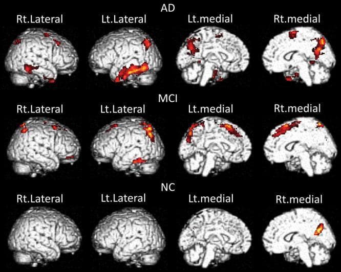 This diagnostic comparison chart utilizes Voxel-Based Morphometry (VBM) on brain MRI renderings to illustrate the correlation between BF-227 PET uptake (amyloid-beta deposition) and gray matter atrophy across three clinical groups: Alzheimer's Disease (AD), Mild Cognitive Impairment (MCI), and Normal Controls (NC). The visualization presents four views per group: Right Lateral, Left Lateral, Left Medial, and Right Medial. Significant areas of gray matter volume decrease are highlighted with a heat map (red to yellow). In the AD group, extensive atrophy is visible globally, particularly in the lateral temporal gyrus, precuneus, and cingulate cortex. The MCI group shows a similar but less extensive distribution of atrophy, primarily localized to the medial temporal and superior medial surfaces. In the NC group, atrophy is minimal and highly localized, primarily restricted to the posterior medial regions. This progression illustrates the neuroanatomical evolution of Alzheimer’s disease, highlighting the relationship between amyloid deposition and structural brain volume loss in key regions like the precuneus and temporal lobes.