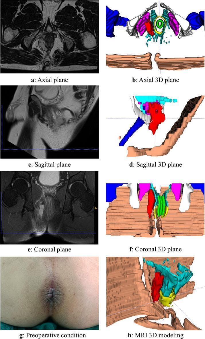A multi-panel medical graphic illustrating an ischiorectal abscess through imaging, 3D reconstruction, and clinical photography. The panel includes original MRI scans in axial (a), sagittal (c), and coronal (e) planes showing a complex fluid collection in the ischiorectal fossa. Adjacent to these are color-coded 3D models (b, d, f, h) that map the abscess (highlighted in red) relative to pelvic anatomy: the levator ani and pelvic floor muscles (blue and brown), the anal canal/sphincters (green and yellow), and pelvic bones (white/gray). The 3D model allows for the assessment of the abscess's spatial extent, demonstrating its position inferior to the levator ani and lateral to the anal canal, which is diagnostic of an ischiorectal location. Panel (g) provides clinical context with a preoperative photograph of the perianal region. This resource is designed for advanced surgical planning and educational visualization of anorectal infections and their complex anatomical relationships within the pelvic floor.