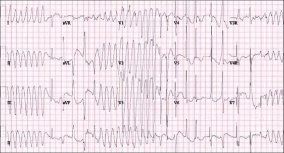 This diagnostic image is a 12-lead surface electrocardiogram (ECG) demonstrating a classic presentation of Torsades de Pointes (TdP), a specific form of polymorphic ventricular tachycardia. The tracing shows rapid, irregular QRS complexes that continuously vary in morphology, axis, and amplitude. A hallmark 'twisting of the points' is visible, where the peaks of the QRS complexes appear to rotate around the isoelectric baseline in a sinusoidal pattern. In leads I, II, III, and V1-V3, the arrhythmia exhibits rhythmic waxing and waning of amplitudes. Conversely, leads V4-V7 show highly disorganized, low-amplitude polymorphic activity. This pattern is clinically significant as it often arises in the setting of prolonged QT intervals (LQTS), such as those caused by congenital channelopathies (LQT1, LQT2, LQT3) or electrolyte imbalances. The image serves as a critical educational tool for identifying life-threatening ventricular arrhythmias that can lead to syncope or sudden cardiac death.