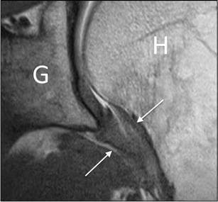 This diagnostic image is a coronal oblique proton density MRI of the glenohumeral joint. Key anatomical landmarks are labeled, including the glenoid (G) and the proximal humerus (H). The focus of the image is the axillary pouch of the joint capsule, indicated by white arrows. Visually, the inferior capsule within the axillary recess demonstrates significant pathological thickening, a hallmark diagnostic feature of adhesive capsulitis (frozen shoulder). Unlike the normally thin and pliable appearance of the capsule, this presentation shows a bulky, intermediate-signal tissue filling the inferior joint space. This imaging modality is utilized in musculoskeletal radiology to assess for capsular inflammation and fibrosis when clinical range of motion is restricted. The image illustrates the relationship between the joint capsule's morphological changes and the surrounding bony structures, providing clear visual evidence of the soft tissue involvement in adhesive capsulitis.