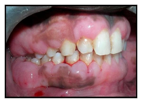 This intraoral clinical photograph displays significant generalized gingival enlargement (gingival fibromatosis) in a patient. The gingival tissue is pale pink, dense, and firm in appearance, exhibiting a bulbous, nodular, and irregular surface texture. The overgrowth is extensive, covering a substantial portion of the clinical crowns of both the maxillary and mandibular teeth, particularly in the posterior regions. Distinctive dark, pinpoint markings are visible on the gingival surface, representing bleeding points created by a pocket marker to guide surgical excision (gingivectomy). The teeth that remain visible show some crowding and plaque accumulation near the gingival margins. Physiological pigmentation (melanosis) is also present as brownish patches on the keratinized gingiva. This image serves as a clinical demonstration of hereditary or idiopathic gingival overgrowth and the preoperative marking phase of periodontal surgery.