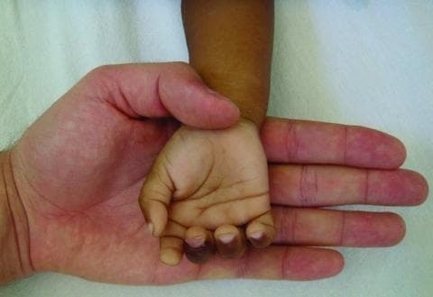 This clinical photograph provides a side-by-side comparison between the palmar surface of a 2-year-old child's hand and that of a healthy adult. The image serves as a classic visual demonstration of severe clinical pallor. The child's hand, associated with a diagnostic hemoglobin level of 3.6 g/dL (severe anemia), exhibits a marked loss of normal pinkish hue, appearing significantly lighter and almost white compared to the adult hand. This contrast is most evident in the palmar creases and the nail beds, which lack the typical capillary refill color. The adult hand displays normal skin perfusion and saturation, providing a reference point for healthy oxygenation. This visual aid is primarily used in hematology and pediatrics to teach the physical signs of extreme anemia, often secondary to conditions such as Plasmodium vivax malaria infection as indicated by the clinical context. It illustrates the importance of physical examination in identifying life-threatening reductions in red blood cell mass or hemoglobin concentration.