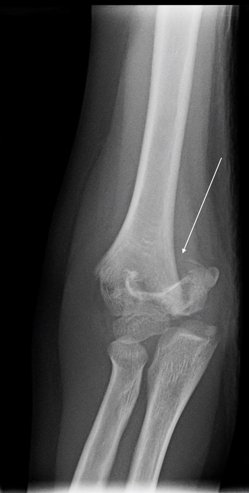 This diagnostic image is an anteroposterior (AP) radiograph of a pediatric elbow, demonstrating a supracondylar humerus fracture. A clear transverse fracture line is visible across the distal humerus, just proximal to the epicondyles. An arrow indicates the site of cortical disruption on the lateral aspect. The distal fracture fragment exhibits displacement and rotational malalignment relative to the humeral shaft, disrupting the normal anatomical relationship between the distal humerus and the articulating proximal radius and ulna. The appearance is consistent with a Gartland Type II supracondylar fracture, a common pediatric orthopedic injury typically resulting from a fall on an outstretched hand. Key educational features include the visualization of the supracondylar fracture pattern, the assessment of coronal plane displacement, and the evaluation of the elbow joint's overall alignment in a skeletally immature patient.