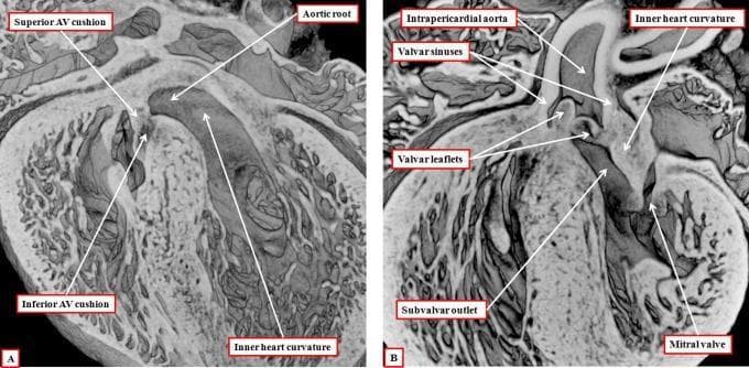 Two high-resolution episcopic data set images (A and B) illustrating the cardiac embryology of mouse hearts at the 15th day of development, used as models for human cardiac morphogenesis. Panel A demonstrates the atrioventricular (AV) region, highlighting the superior and inferior AV cushions as they approximate to close the persisting embryonic interventricular communication. The inner heart curvature is visible adjacent to the developing aortic root. Panel B shows the heart subsequent to foramen closure, emphasizing the spatial relationship between the outflow tract and the left ventricle. Labeled structures include the intrapericardial aorta, valvar sinuses, valvar leaflets, and the subvalvar outlet. The inner heart curvature is clearly interposed between the developing aortic valve leaflets and the mitral valve, illustrating the transitional stage before the formation of adult aortic-to-mitral fibrous continuity. These images provide critical educational insight into the remodeling of the proximal outflow tract and the septation of the ventricular chambers during cardiogenesis.