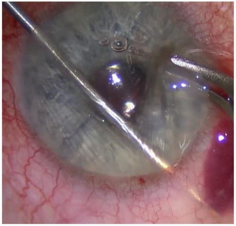 This clinical photograph is an intraoperative view of an ophthalmic surgical procedure, specifically a XEN Gel Stent implantation for glaucoma management. The image displays the anterior segment of the eye with a thin, metallic injector inserted through a temporal-inferior side port incision. The injector traverses the anterior chamber, with its distal tip positioned approximately 2 mm posterior to the corneal limbus, residing underneath the conjunctiva to facilitate the ab interno creation of a subconjunctival drainage bleb. The conjunctiva shows localized vascular congestion and mild erythema, consistent with surgical manipulation and the administration of mitomycin C. The cornea remains relatively transparent but exhibits surface reflections and minor irregularities likely due to the application of viscoelastic substances. Small air bubbles are visible within the fluid-filled space above the cornea. This visual demonstrates the precise needle-passing technique required to bridge the anterior chamber and the subconjunctival space to ensure proper stent placement for intraocular pressure reduction.