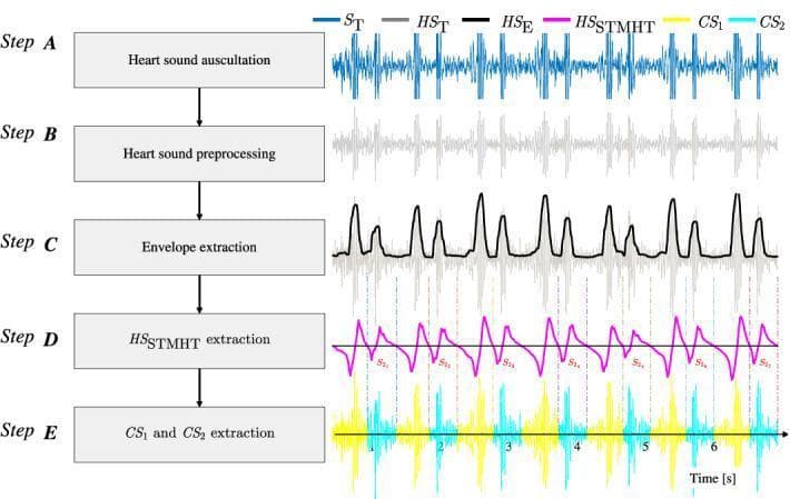 This flowchart illustrates the signal processing methodology for the automated segmentation and extraction of heart sound components, specifically the first (S1) and second (S2) heart sounds, denoted as CS1 and CS2. The process is divided into five sequential stages (Step A through Step E):
1. Step A (Heart Sound Auscultation): Shows the raw digital phonocardiogram signal (ST) as a blue oscillatory waveform.
2. Step B (Heart Sound Preprocessing): Displays a filtered and normalized version of the signal (HST) in gray, reducing noise and baseline drift.
3. Step C (Envelope Extraction): Features a black waveform representing the extracted Viola integral-based envelope (HSE) that traces the signal peaks.
4. Step D (HS STMHT Extraction): Shows a magenta waveform (HS_STMHT) using the Short-Time Modified Hilbert Transform, with marked negative-to-positive points used to identify S1 and S2 centroids.
5. Step E (CS1 and CS2 Extraction): Demonstrates the final segmented cardiac cycle components, with CS1 segments in yellow and CS2 segments in cyan, separated by vertical hashed lines.
This educational diagram represents an advanced diagnostic algorithm for cardiovascular signal processing, aimed at enhancing automated cardiac auscultation.