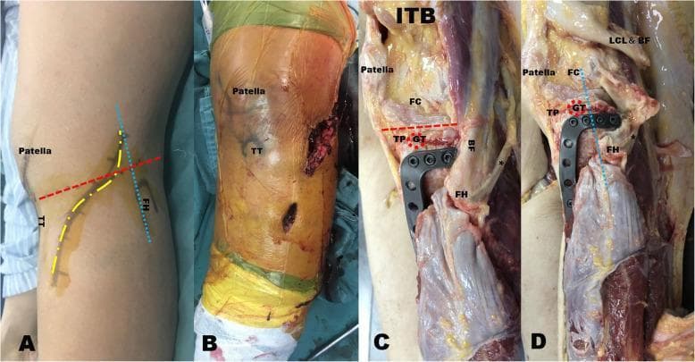 This composite of clinical and anatomical images illustrates a modified anterolateral surgical approach for treating posterolateral tibial plateau fractures. Panel A displays the planned curved incision (yellow dotted line) on the lateral knee, positioned between the tibial tubercle (TT) and the anterior edge of the fibular head (blue dotted line), intersecting the joint line (red dashed line). Panel B shows the actual surgical incision in an intraoperative setting. Panels C and D provide fresh specimen dissections demonstrating the anatomical depth and implant placement. Key structures identified include the femoral condyle (FC), patella, tibial plateau (TP), and Gerdy’s tubercle (GT), which is detached in these views (red dotted circle). The novel reverse L-shaped anatomical plate is shown secured to the posterolateral tibial plateau. Panel D specifically highlights the detachment and retraction of the biceps femoris (BF) and lateral collateral ligament (LCL) to facilitate plate fixation. The images emphasize the plate's ability to provide subchondral support via multiple rafting screws while avoiding extensive posterior dissection near the common peroneal nerve.