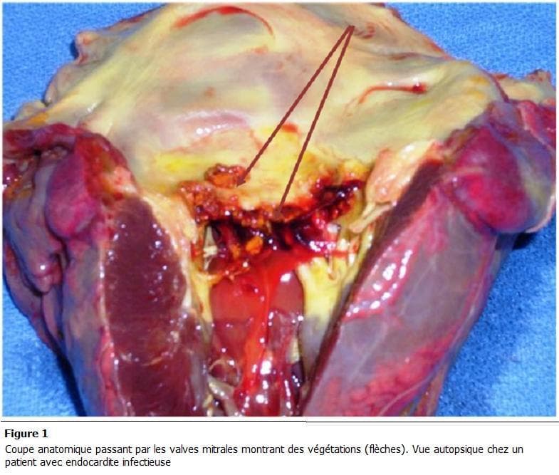 This clinical photograph displays a gross anatomical autopsy section of a human heart, focusing on the mitral valve apparatus. The image serves as a pathological specimen demonstrating infective endocarditis. Key findings include the presence of friable, irregular, brownish-red masses, identified as vegetations (indicated by arrows), attached to the mitral valve leaflets. The leaflets themselves show significant structural disruption, ulceration, and non-uniform thickening. Surrounding tissues exhibit signs of acute pathology, including hemorrhagic areas (deep red), inflammatory changes, and yellowish epicardial or valvular fat deposits. The underlying myocardium appears congested. This visual illustrates the hallmark gross features of valvular destruction and vegetation formation in bacterial endocarditis, highlighting the clinical relevance of the condition in causing valvular insufficiency and potential embolic events. The content is suitable for advanced medical education in pathology and cardiology, specifically regarding the morphological manifestations of endocardial infections.