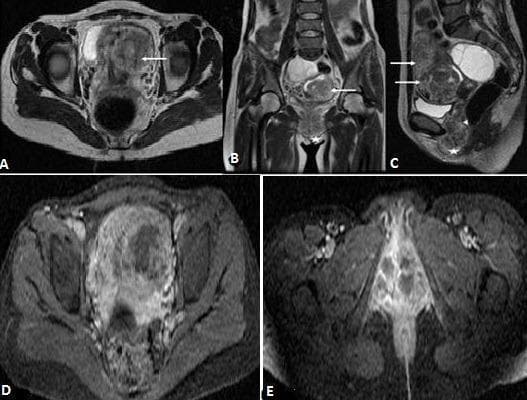 This diagnostic image composite displays pelvic Magnetic Resonance Imaging (MRI) findings in a case of Gestational Trophoblastic Neoplasia (GTN), likely an invasive mole or choriocarcinoma. Panels A, B, and C are T2-weighted sequences in axial, coronal, and sagittal planes, respectively. They reveal an enlarged uterus containing a bulky, heterogeneous tissue mass that extensively invades the myometrium (indicated by arrows). The sagittal view (C) demonstrates downward locoregional extension into the vaginal wall (arrowhead) and the labia majora (star symbol). Panels D and E show post-gadolinium T1-weighted axial images with fat saturation. These images exhibit a markedly heterogeneous enhancement pattern throughout the uterine mass. Prominent, well-demarcated non-enhancing zones are visible within the lesion, characteristic of necrotic regions common in rapidly growing trophoblastic tumors. The imaging highlights the aggressive, hypervascular nature of the tumor and its capacity for deep structural invasion into the pelvic floor, serving as a critical tool for FIGO staging and treatment planning in gynecologic oncology.
