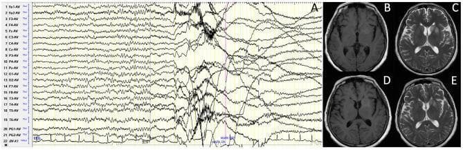 This composite educational graphic displays diagnostic findings from a 63-year-old female with LGI1 antibody-associated autoimmune encephalitis. Panel A shows an ictal EEG recording of a faciobranchial dystonia seizure (FBDS). The tracing demonstrates a 1-second electrodecremental event (amplitude suppression) across all leads immediately preceding clinical onset, followed by high-amplitude movement artifacts and a return to background rhythm. Panels B through E present axial brain MRI scans focusing on the basal ganglia. Images B (T1-weighted) and C (T2-weighted) were captured 19 days after symptom onset, revealing hyperintense signals in the left caudate and lenticular nuclei. Images D (T1-weighted) and E (T2-weighted) show follow-up imaging 33 days after onset (10 days post-immunotherapy), demonstrating significant radiological improvement with resolution of the previously seen signal abnormalities. The content illustrates the characteristic electroclinical and neuroimaging features of LGI1-AE and its responsiveness to treatment.