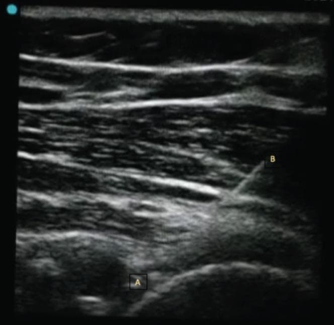 This diagnostic ultrasound image in a transverse view demonstrates an ultrasound-guided interventional procedure on the glenohumeral joint (A) using a posterior approach. The image shows the musculoskeletal anatomy of the shoulder, including the superficial subcutaneous tissue and muscular layers (deltoid and infraspinatus) characterized by heterogeneous echogenicity with hyperechoic fascial planes and hypoechoic muscle bundles. An injecting needle (B) is clearly visible as a distinct, linear, hyperechoic structure traversing the soft tissue planes toward the posterior aspect of the glenohumeral joint capsule. The educational focus of this image is to illustrate the precise needle trajectory required for hydrodilatation or intra-articular injection. The visualization confirms the needle's position relative to the humeral head and glenoid margin, highlighting the clinical significance of real-time ultrasound guidance in ensuring accurate delivery of therapeutics into the joint space while avoiding neurovascular structures.