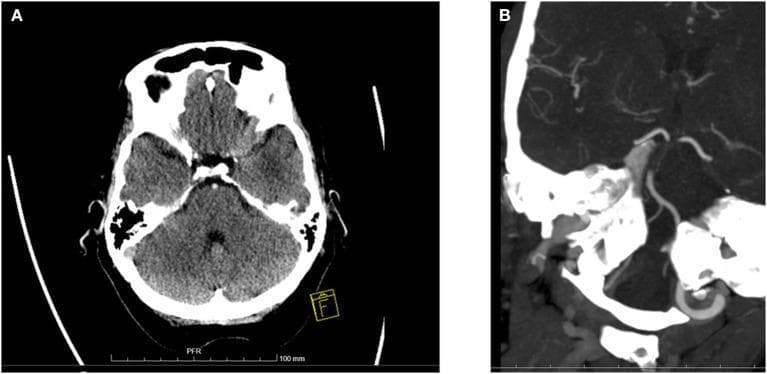 This diagnostic imaging panel demonstrates basilar artery occlusion (BAO) and associated posterior circulation ischemic changes. Figure A is an axial non-contrast CT scan of the brain at the level of the posterior fossa, showing diffuse hypodensity in the pons and both cerebellar hemispheres, indicative of acute infarction or edema. A hyperdense basilar artery sign is also visible, suggesting acute thrombus. Figure B is a CT angiography (CTA) image in a coronal-oblique projection, revealing a long-segment filling defect and abrupt vessel cut-off involving the mid and caudal portions of the basilar artery, confirming a diagnosis of basilar artery occlusion. These images illustrate key neuroradiological findings used in the pc-ASPECTS (posterior circulation Acute Stroke Prognosis Early CT Score) system for evaluating stroke severity and predicting clinical outcomes in patients presenting with comatose states or neurological deficits related to the posterior circulation.