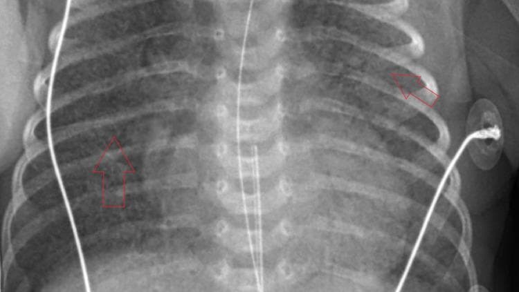 Anteroposterior (AP) chest X-ray of a neonate demonstrating classic radiographic features of neonatal respiratory distress syndrome, also known as hyaline membrane disease. The image shows diffuse, bilateral, and symmetric reticulogranular (ground-glass) opacities throughout both lung fields. These granular infiltrates, highlighted by red arrows, represent widespread alveolar atelectasis and result in reduced lung volumes and obscured vascular markings. The cardiomediastinal silhouette is visible but slightly blurred by the surrounding parenchymal opacification. Several medical devices are present, including an endotracheal tube, an umbilical catheter, and external leads, consistent with a patient receiving intensive care in a neonatal NICU setting. This imaging is characteristic of surfactant deficiency in premature infants, where collapsed alveoli create a fine, stippled appearance across the thorax.