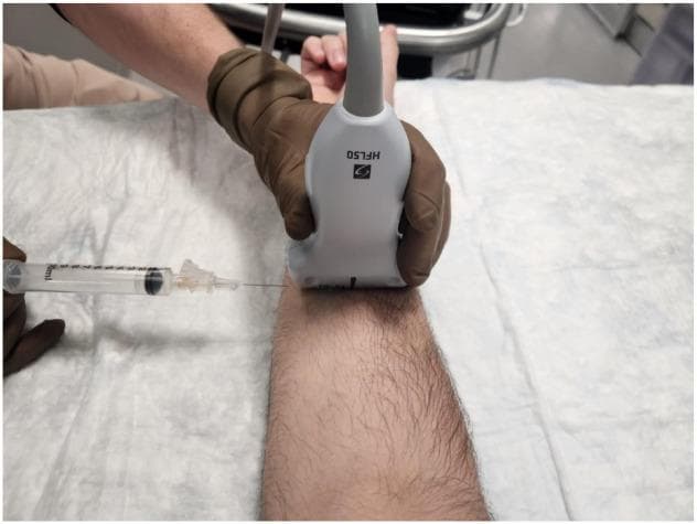 Clinical procedural photograph demonstrating the setup for an ultrasound-guided median nerve block in the mid-forearm. A clinician, wearing brown sterile gloves, holds a high-frequency linear ultrasound probe (labeled HFL50) in a transverse orientation on the volar aspect of a patient's forearm. Simultaneously, a clear syringe with a fine-gauge needle is shown approaching the skin from the lateral side in an in-plane technique. The in-plane approach is characterized by the needle being parallel to the long axis of the probe, allowing for continuous visualization of the needle shaft and tip as it traverses the soft tissue towards the target nerve. This image illustrates the ergonomic positioning and spatial relationship between the ultrasound transducer and the needle used for hydrodissection or regional anesthesia in the management of conditions such as Carpal Tunnel Syndrome (CTS).