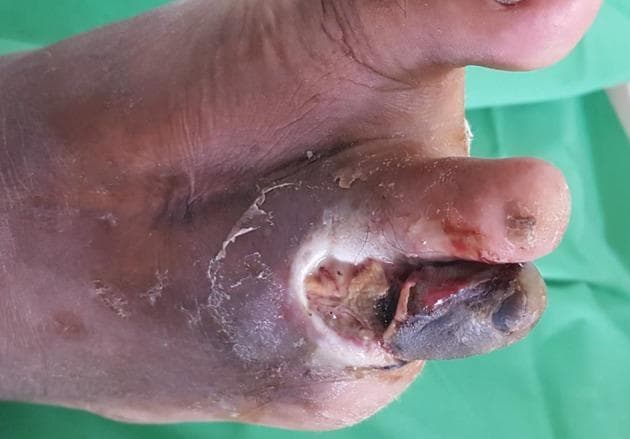 This clinical photograph displays a high-risk diabetic foot with advanced complications, including a deep neuropathic or neuro-ischaemic ulcer and dry gangrene. The primary lesion is a large, deep ulcer located on the dorsal aspect of the forefoot at the base of the second toe. The ulcer bed contains a mixture of yellowish slough and fibrin alongside areas of darker necrotic tissue. Surrounding the ulcer, the skin is markedly macerated with significant purplish-black discoloration, suggesting severe ischaemia and compromised blood flow. The distal portion of the second toe is distinctly cyanotic and black, consistent with gangrene, and shows signs of tissue integrity loss and small areas of haemorrhage. A surgical scar is visible on the midfoot, indicating a previous toe amputation, which classifies this as a high-risk limb. The image serves as a critical educational example of diabetic foot disease progression, emphasizing the confluence of peripheral neuropathy and peripheral arterial disease in clinical practice.