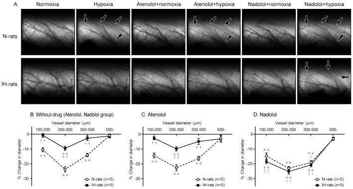 This composite educational graphic presents microangiographic imaging and quantitative data regarding Hypoxic Pulmonary Vasoconstriction (HPV). Panel A displays a matrix of selective pulmonary microangiograms comparing N-rats (normoxic-raised) and IH-rats (intermittent hypoxia-raised) under various conditions: normoxia, acute hypoxia, and hypoxia following pretreatment with beta-blockers Atenolol (beta-1 selective) or Nadolol (non-selective beta-1/beta-2). In N-rats, acute hypoxia induces visible narrowing of small pulmonary arteries (indicated by black arrows). This response is blunted in IH-rats but significantly restored after Nadolol administration, suggesting beta-2 adrenergic receptor involvement in IH-induced HPV attenuation. Panels B, C, and D provide quantitative line graphs plotting '% change in diameter' against 'vessel diameter (micrometers)' for these cohorts. The data highlights that HPV is most pronounced in vessels measuring 200–300 µm. The graphs statistically confirm that while Atenolol does not correct the blunted HPV in IH-rats, Nadolol returns the vasoconstrictive response to levels comparable to N-rats. This visual illustrates the pathophysiology of pulmonary vascular reactivity and the role of peripheral beta-adrenergic receptors in chronic hypoxia adaptations.