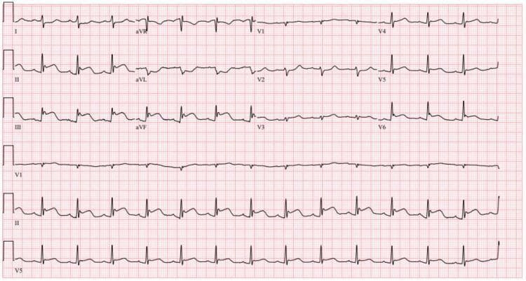 A standard 12-lead electrocardiogram (ECG) printed on standard red grid paper, demonstrating findings consistent with an acute inferior wall myocardial infarction (STEMI). The primary visual pathology includes significant ST-segment elevation in the inferior leads (II, III, and aVF). In lead III, the ST elevation is more pronounced than in lead II, a feature often associated with right ventricular involvement or a right coronary artery (RCA) occlusion. Reciprocal ST-segment depressions are visible in the lateral leads, particularly in lead I and aVL. The precordial leads (V1-V6) show mild ST-segment changes, with some flattening in V2 and V3. The QRS complexes are relatively narrow, and the baseline rhythm appears to be a regular sinus rhythm. This diagnostic image serves as a classic educational example of an ST-elevation myocardial infarction (STEMI) involving the inferior myocardial wall, highlighting the importance of recognizing regional lead patterns and reciprocal changes in emergency cardiology.